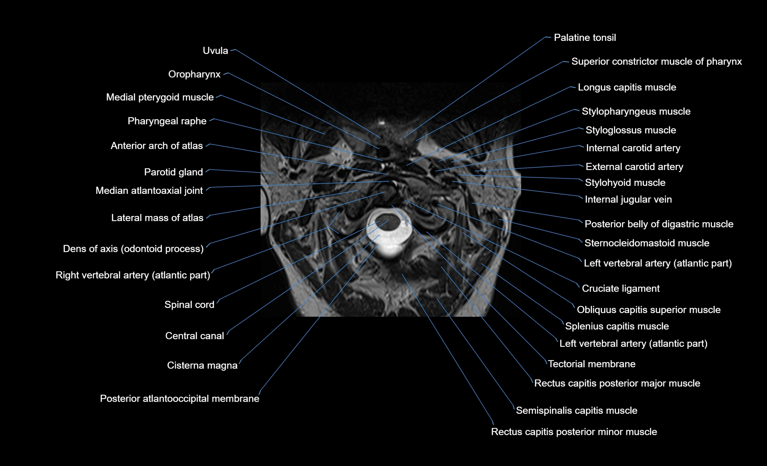 cervical spine cross sectional MRI anatomy  3T MRI axial  image-img-00001-00005.webp